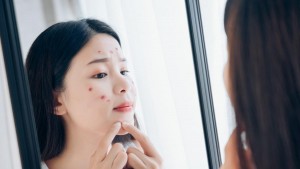 Kulit Berminyak Berjerawat